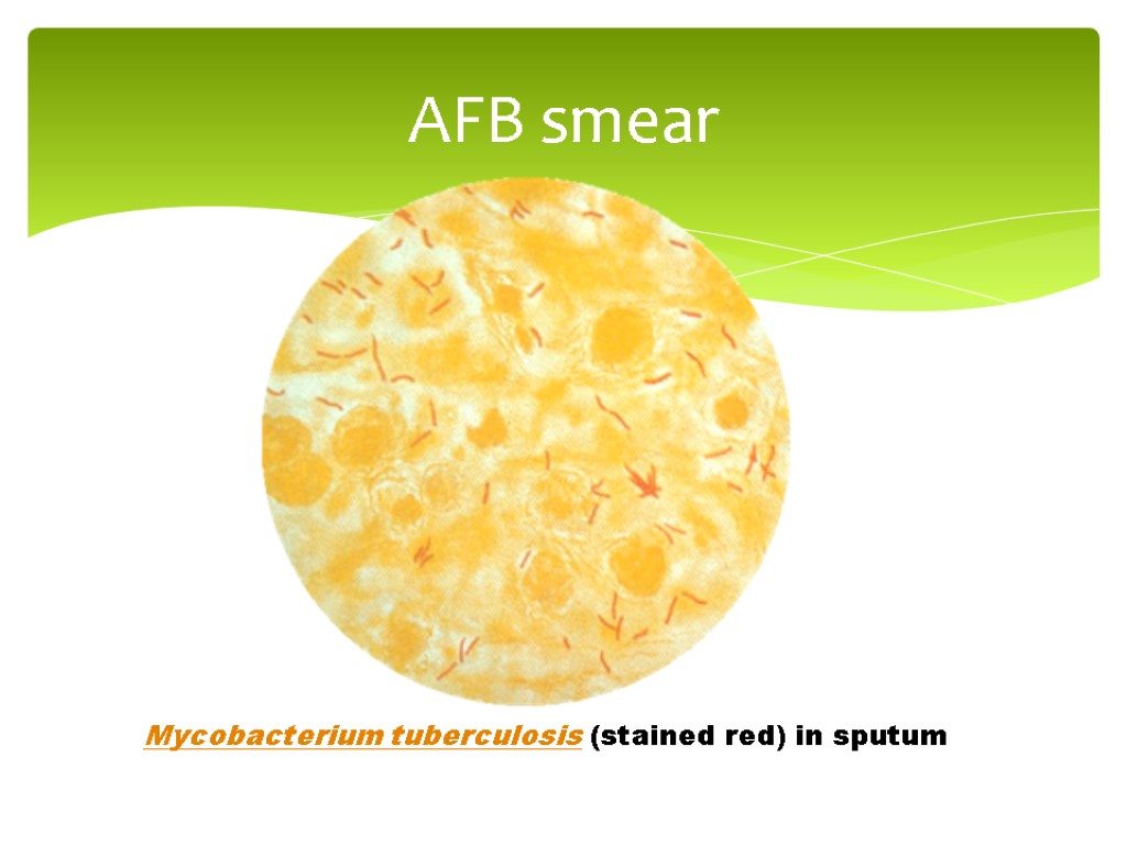 AFB smear Mycobacterium tuberculosis (stained red) in sputum